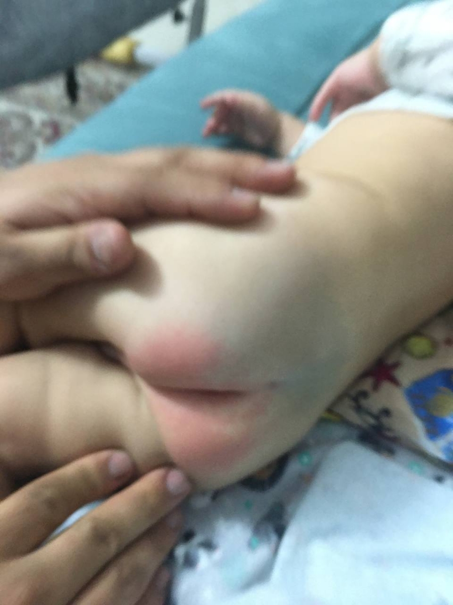 علت قرمز شدن دور مقعد چیست