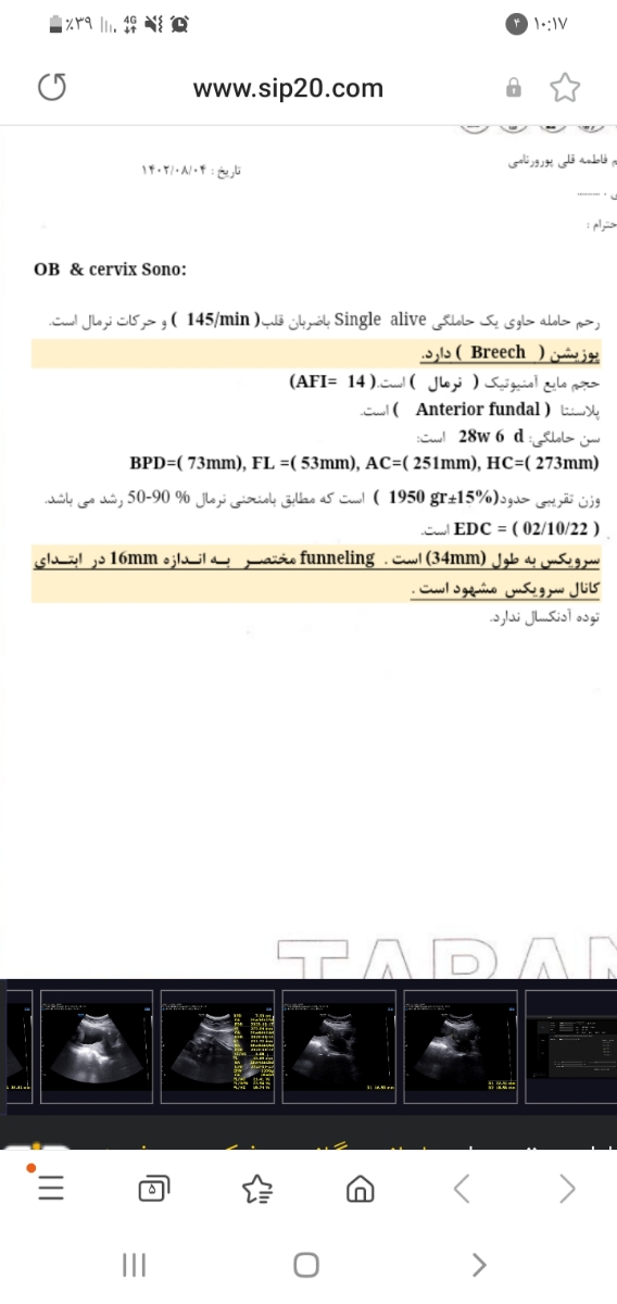 فانلیگ شدن دهانه رحم در ۲۹ هفته