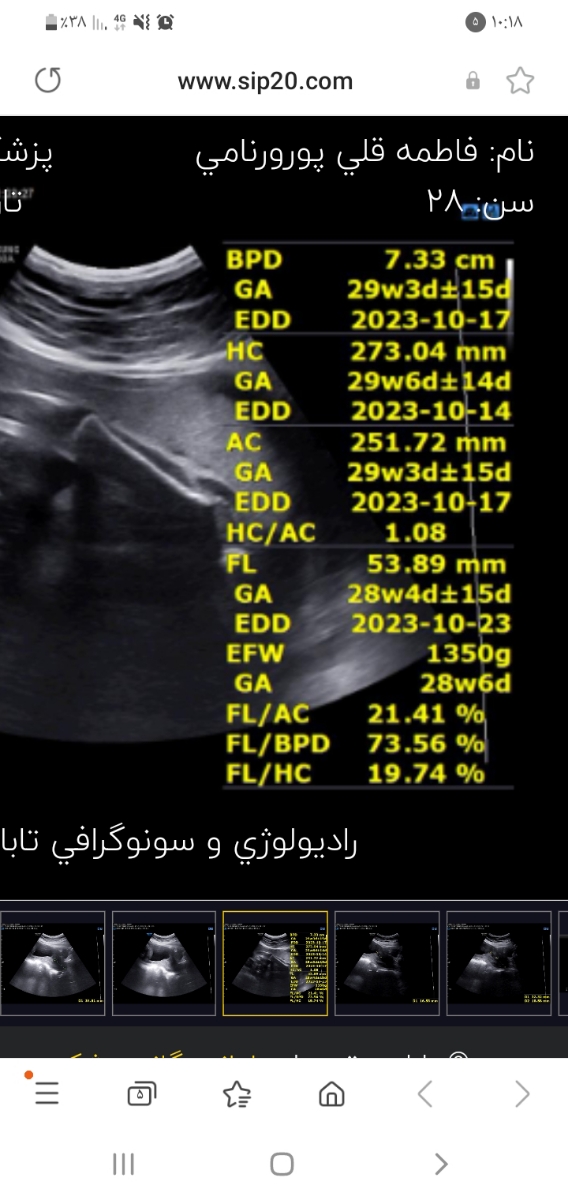 فانلیگ شدن دهانه رحم در ۲۹ هفته