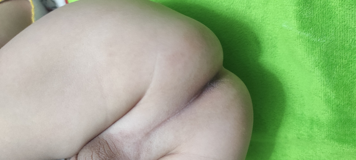 علت قرمز شدن دور مقعد چیست