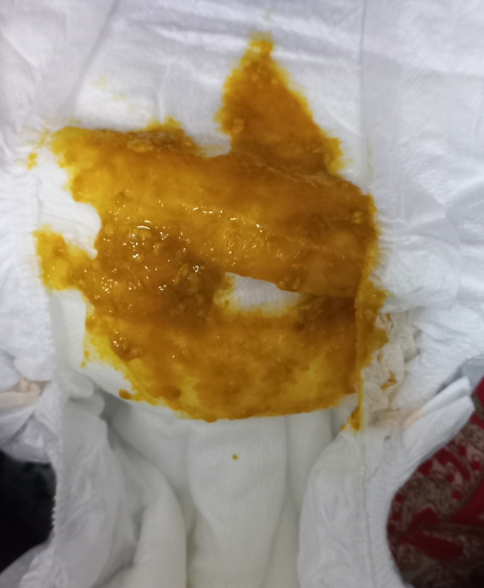 مدفوع خیلی ابکی نوزاد دلیلش چیه با عکس مدفوع خیلی ابکی نوزاد دلیلش چیه با عکس
