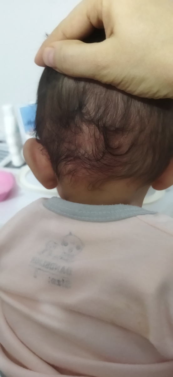 حساسیت نوزاد پنج ماهه به شامپو حساسیت نوزاد پنج ماهه به شامپو