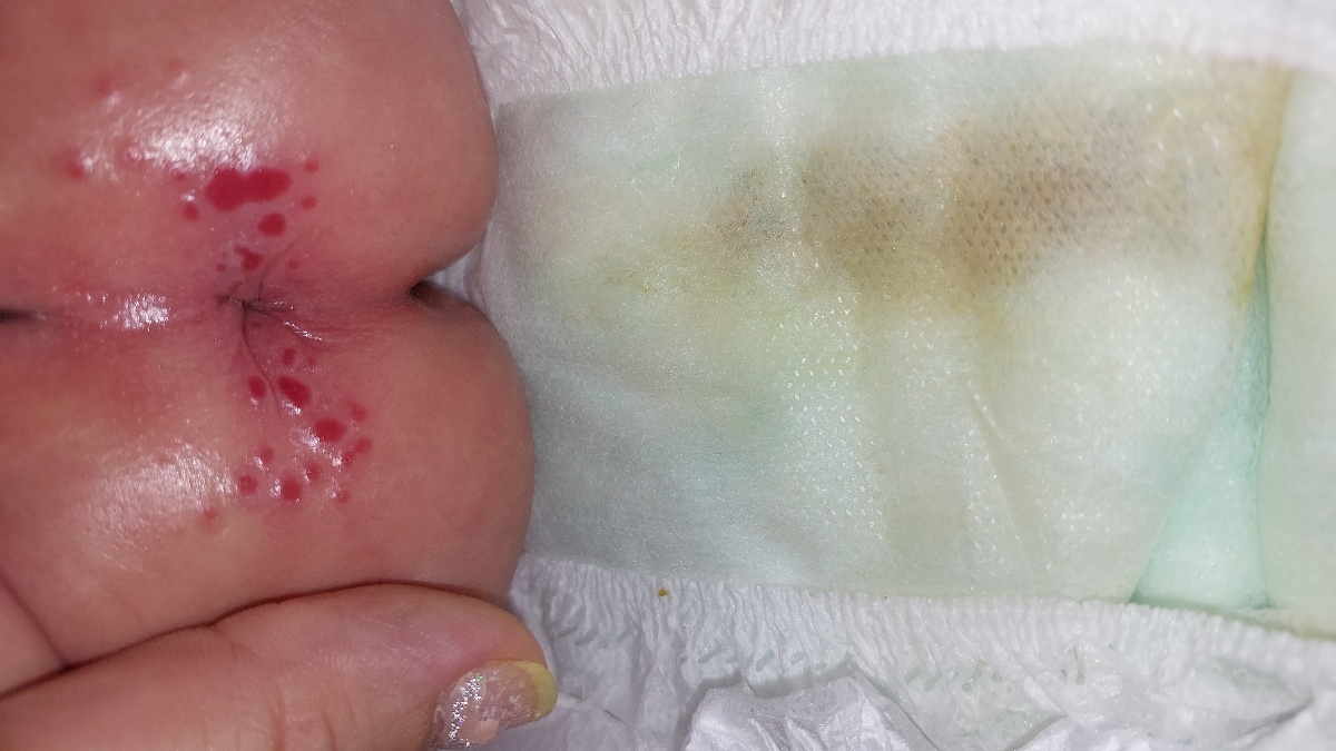 شقاق یافیشرمقعدنوزادیک ماهه(باعکس) شقاق یافیشرمقعدنوزادیک ماهه(باعکس)