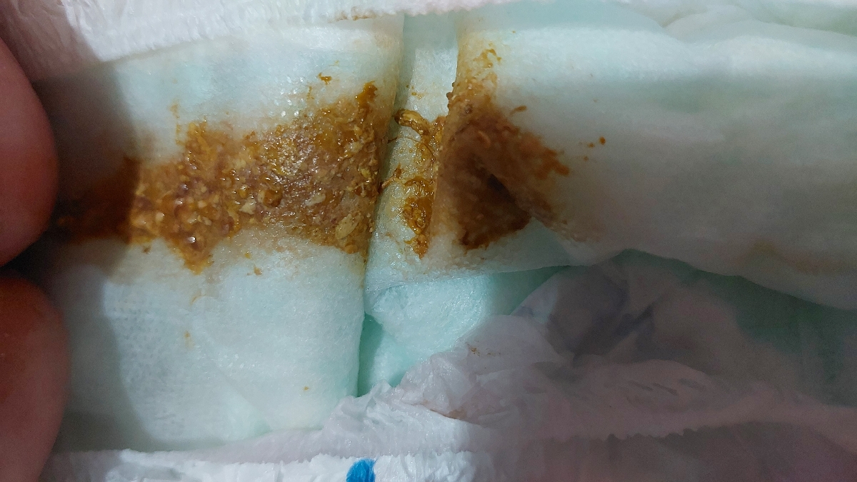 شقاق یافیشرمقعدنوزادیک ماهه(باعکس) شقاق یافیشرمقعدنوزادیک ماهه(باعکس)