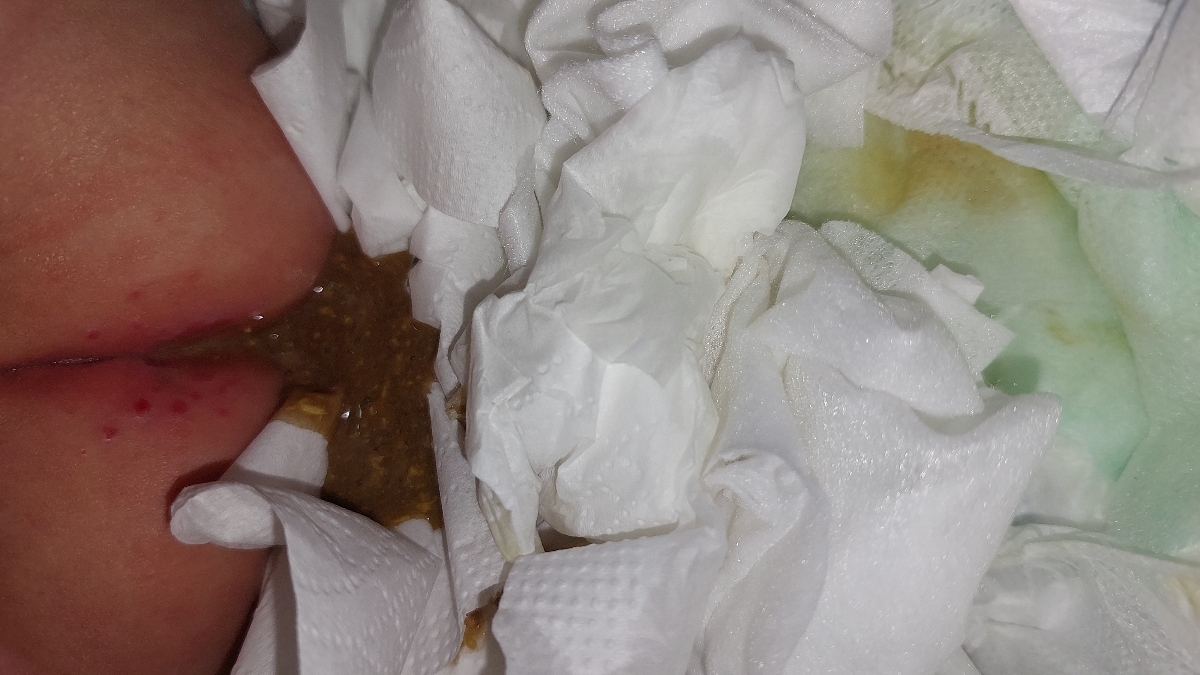 شقاق یافیشرمقعدنوزادیک ماهه(باعکس) شقاق یافیشرمقعدنوزادیک ماهه(باعکس)