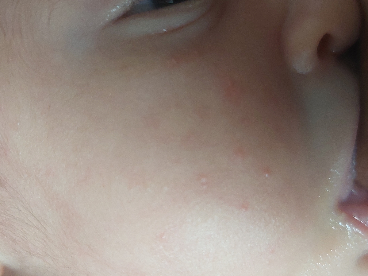 حساسیت ب شیر خشک نوزاد رفلاکسی حساسیت ب شیر خشک نوزاد رفلاکسی