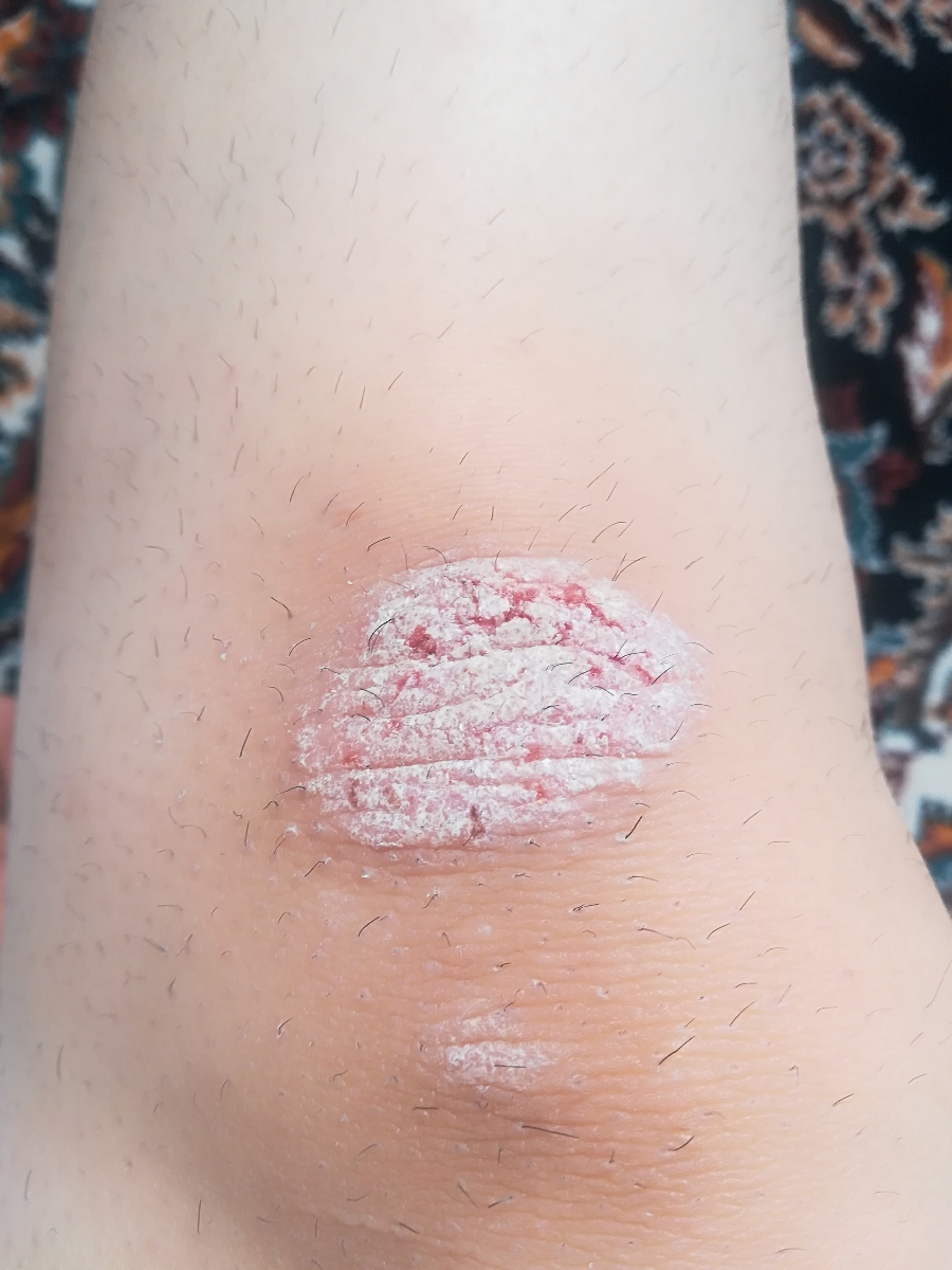 خشکی آرنج و زانو خشکی آرنج و زانو