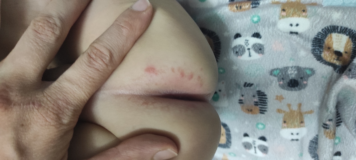 علت قرمز شدن دور مقعد چیست