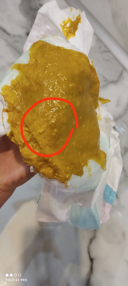 دیدن خون در مدفوع دیدن خون در مدفوع