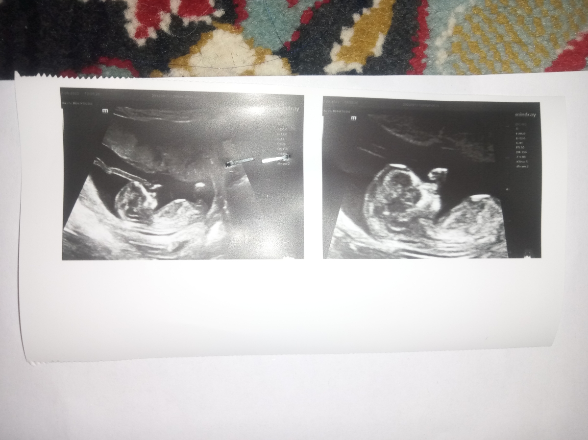 تفسیر آزمایش کامل و سونو NT تفسیر آزمایش کامل و سونو NT