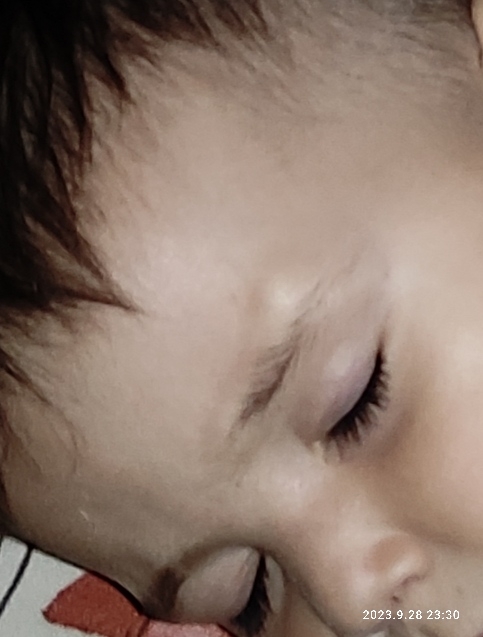 توده چربی یا کیست بالای ابروی پسرم توده چربی یا کیست بالای ابروی پسرم