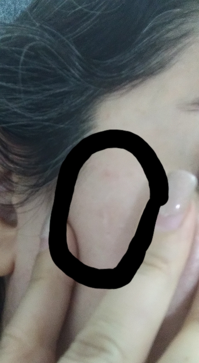 توده چربی یا کیست بالای ابروی پسرم توده چربی یا کیست بالای ابروی پسرم