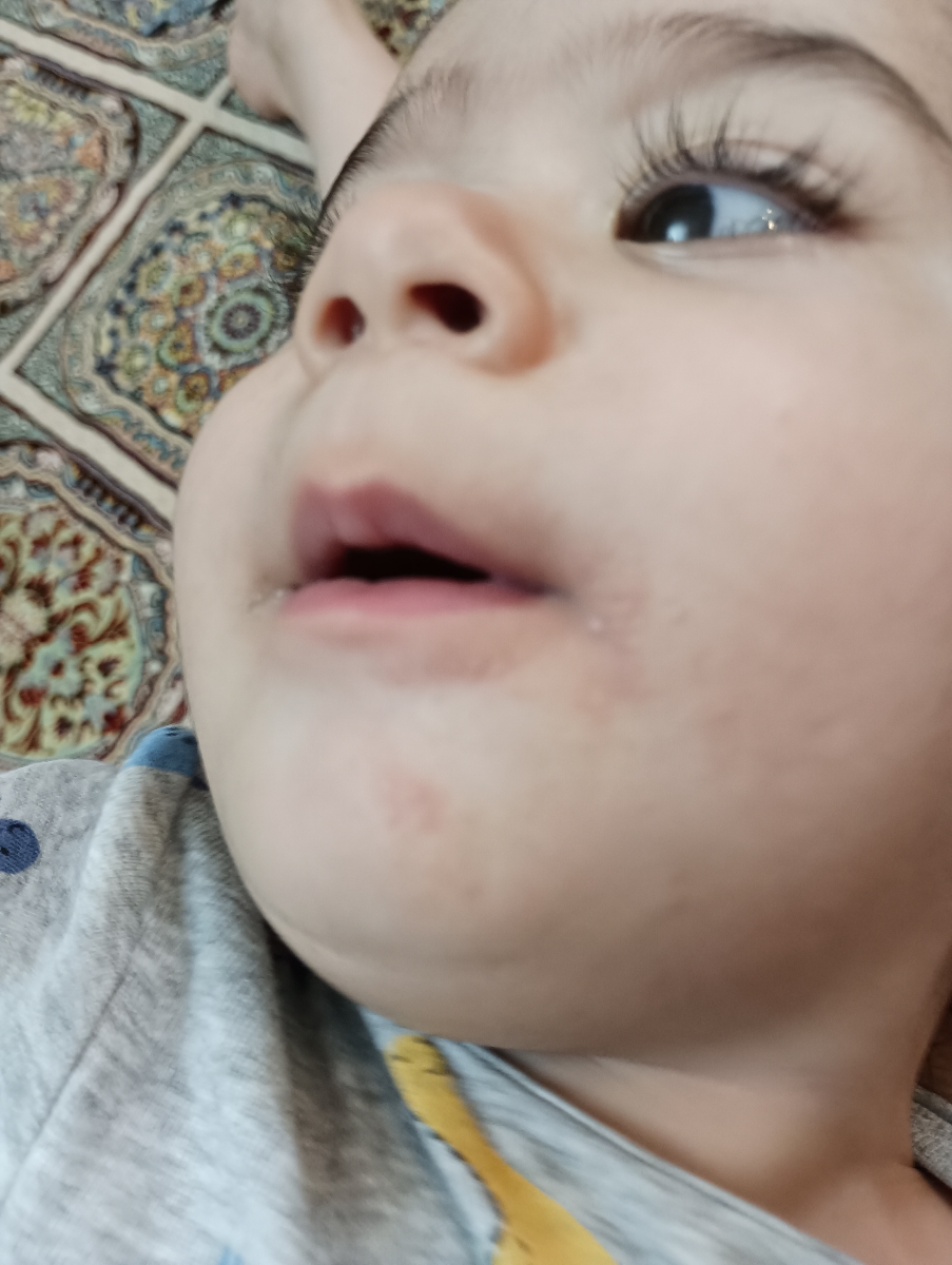 جوش و دونه های ریز اطراف دهان کودک