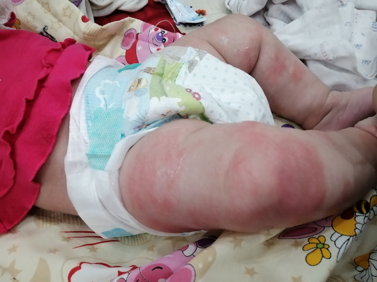 برای اگزما دخترم چکار کنم خوب بشه؟؟؟ برای اگزما دخترم چکار کنم خوب بشه؟؟؟