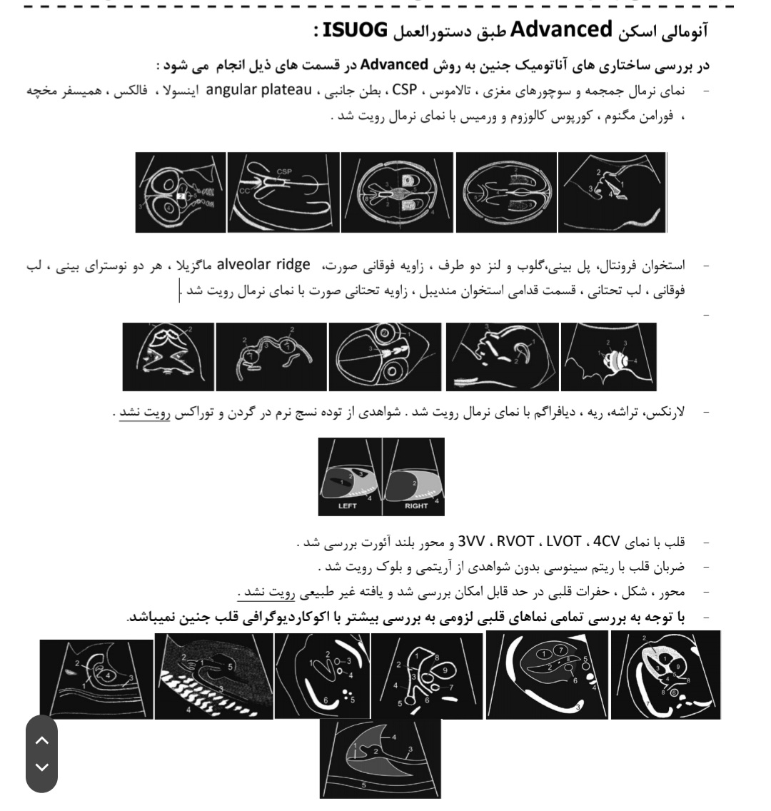 بطن جانبی مغز در آنومالی
