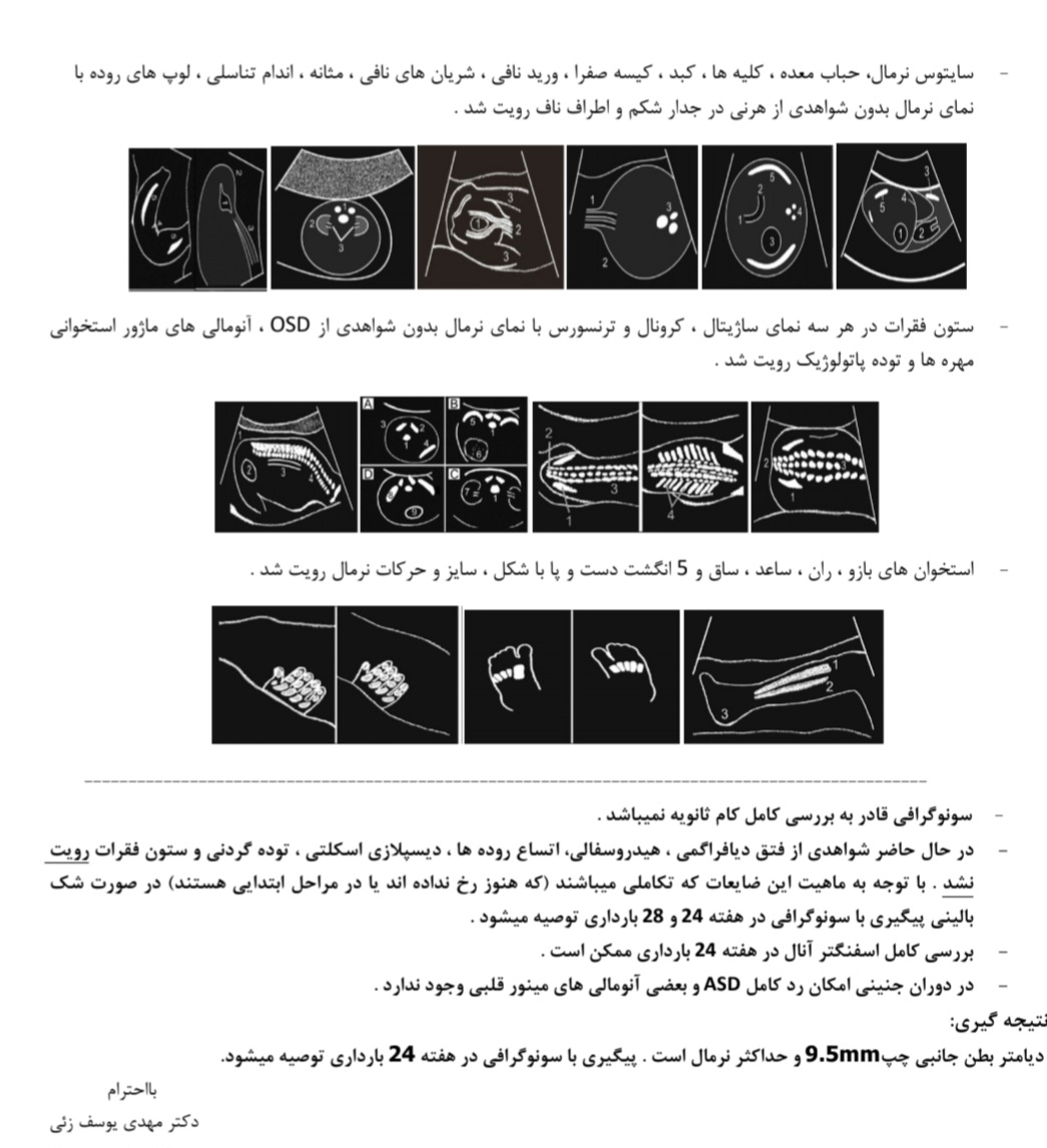 بطن جانبی مغز در آنومالی