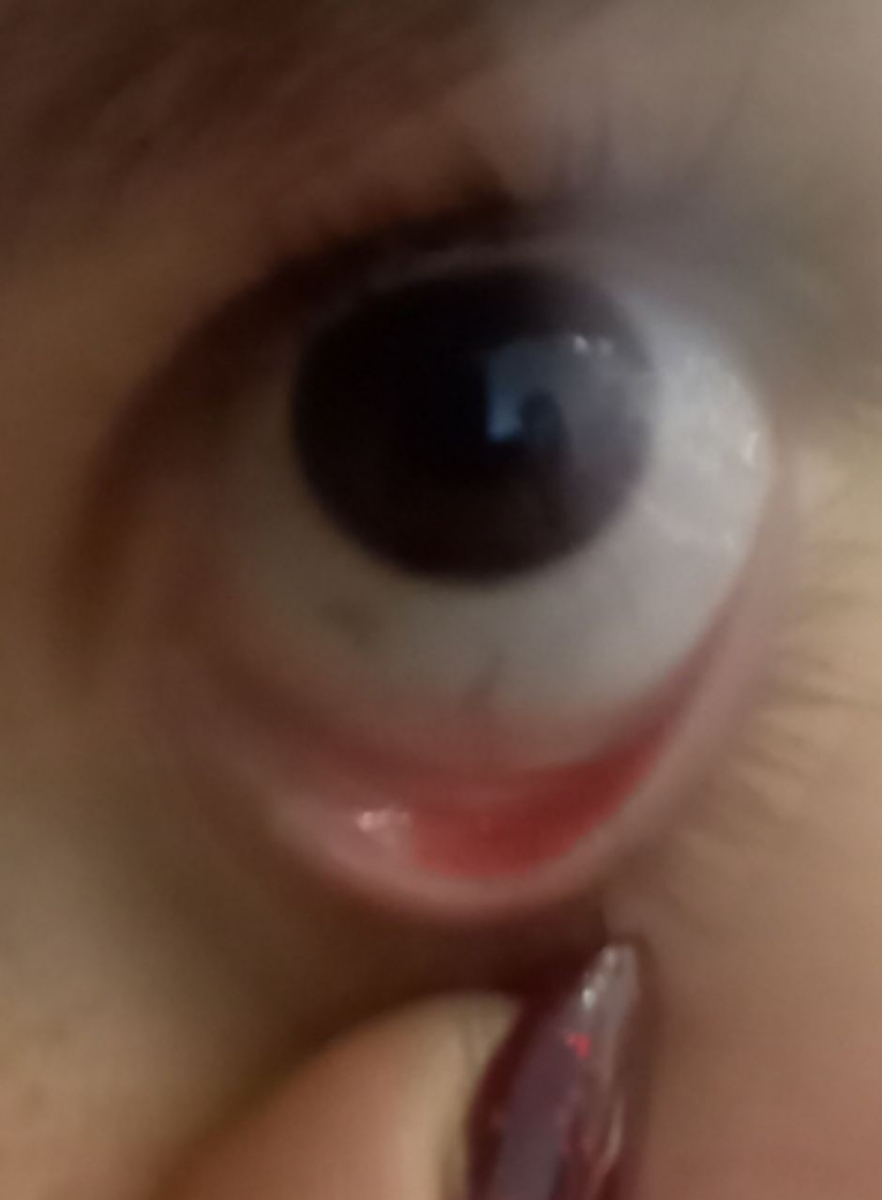 لک خاکستری در سفیدی چشم بچه لک خاکستری در سفیدی چشم بچه