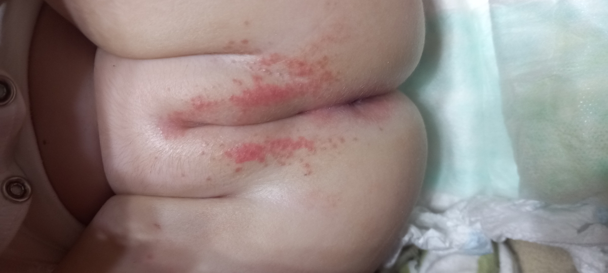 سلام دکتر عزیزم بدن دخترم دونه زده میشه لطفا ببینید چرا اینجوری شده سلام دکتر عزیزم بدن دخترم دونه زده میشه لطفا ببینید چرا اینجوری شده