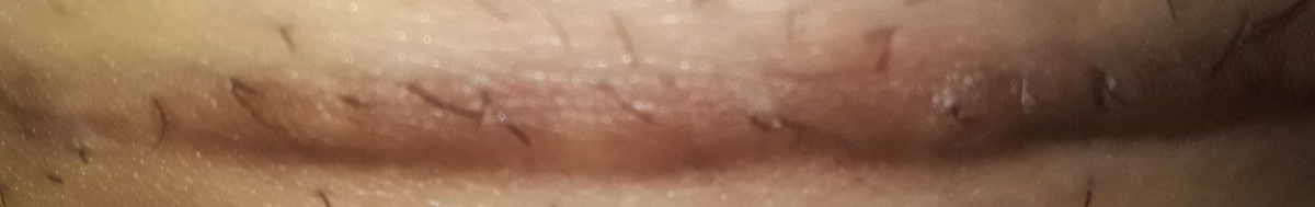 سلام خانم دکتر جای‌ بخیه سزارین توی بارداری دوم رنگش عوض شده علت چیه؟