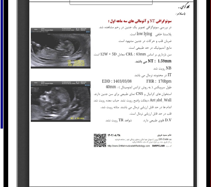 سونو ان تی وتشخیص جنسیت سونو ان تی وتشخیص جنسیت