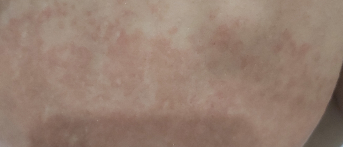 خارش سینه و بدن در شیردهی خارش سینه و بدن در شیردهی