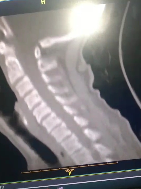 تفسیر سی تی اسکن ستون فقرات🙏🙏 تفسیر سی تی اسکن ستون فقرات🙏🙏