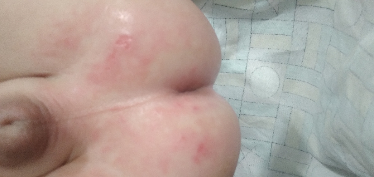 ادرار سوختگی پای نوزاد ادرار سوختگی پای نوزاد