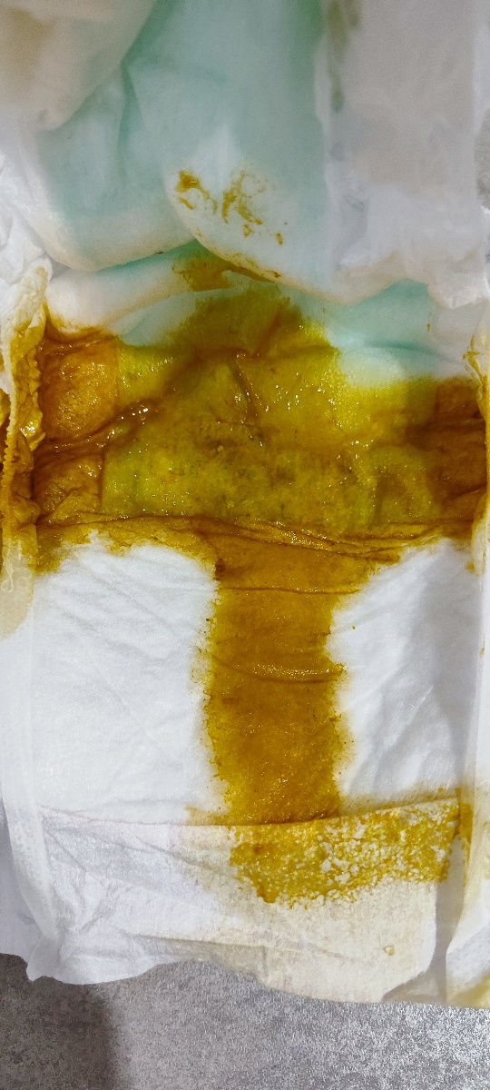 حساسیت به پروتیین گاوی و رفلاکس و استپ وزنی حساسیت به پروتیین گاوی و رفلاکس و استپ وزنی