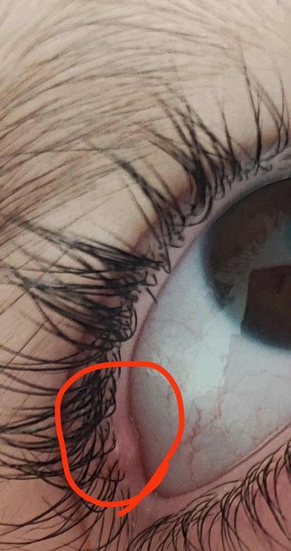 دونه ریز در بالای بن‌مژه کودک