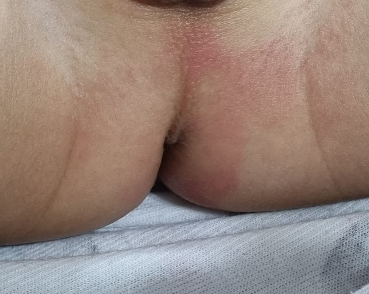 سوختگی پای کودک ۲۰ ماهه بعلت اسهال سوختگی پای کودک ۲۰ ماهه بعلت اسهال