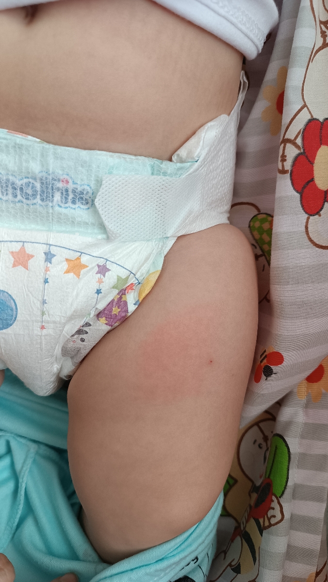 قرمزی اطراف جای واکسن قرمزی اطراف جای واکسن