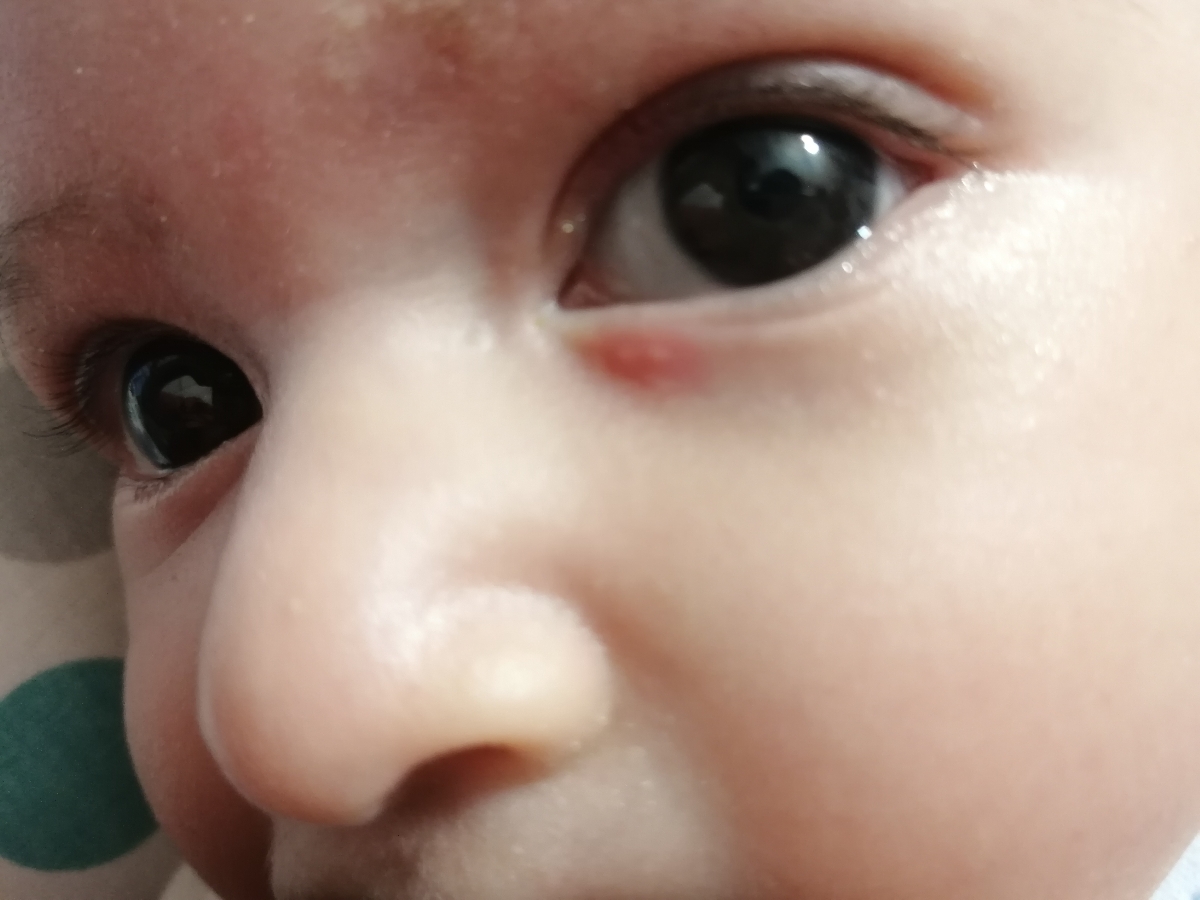 بسته بودن مجرای اشکی بسته بودن مجرای اشکی