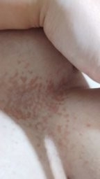 لکه های قهوه ای روی پوست لکه های قهوه ای روی پوست
