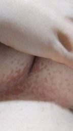 لکه های قهوه ای روی پوست لکه های قهوه ای روی پوست