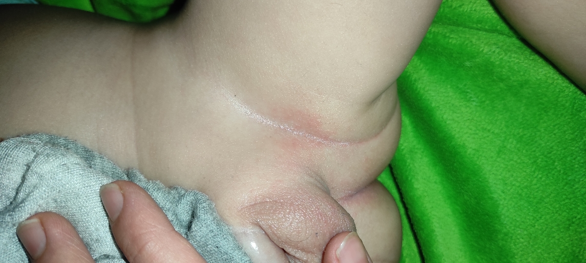 علت قرمز شدن دور مقعد چیست