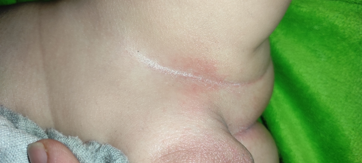 علت قرمز شدن دور مقعد چیست