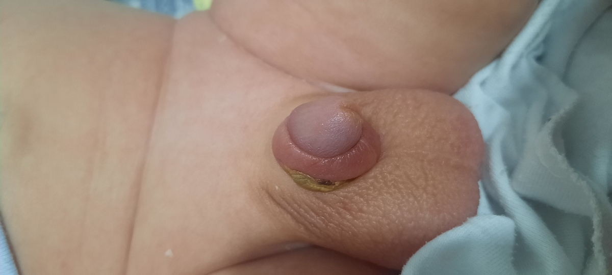 بعد از افتادن حلقه ختنه بعد از افتادن حلقه ختنه