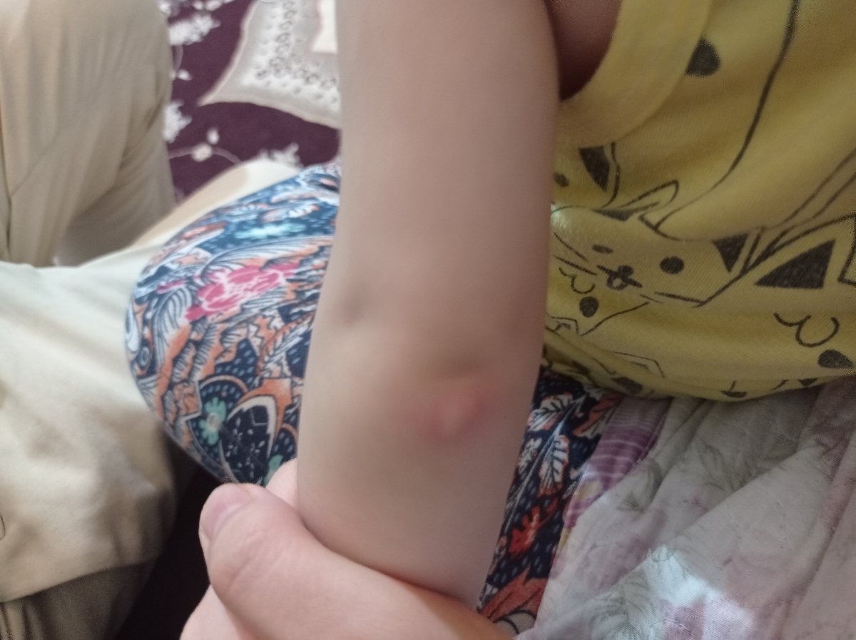 عوارض واکسن ۱۸ ماهگی عوارض واکسن ۱۸ ماهگی