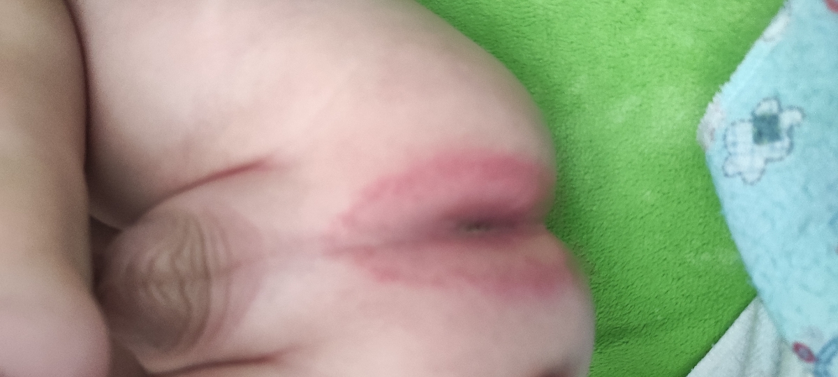 علت قرمز شدن دور مقعد چیست