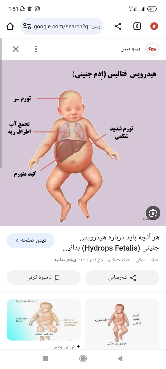 بیماری هیدروپس جنین وختم بارداری