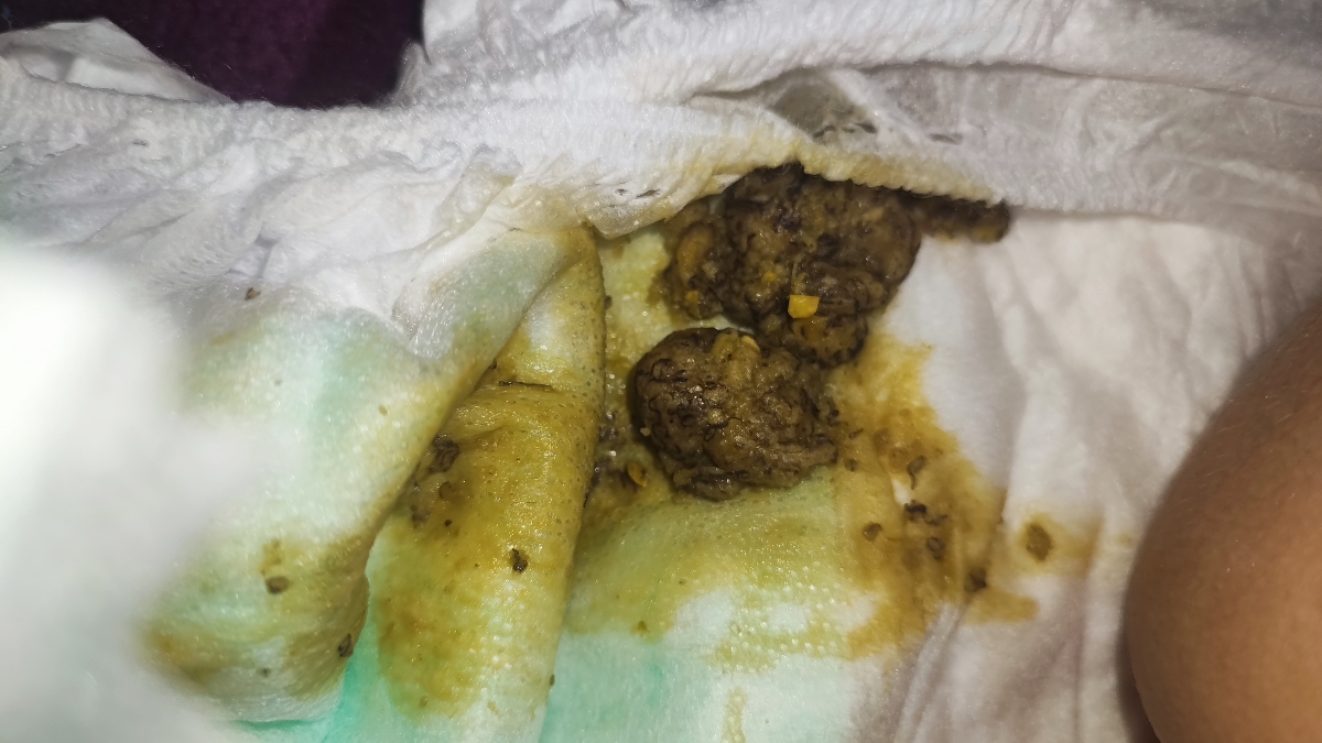 مدفوع شل و و عضم نشدن غذا ..عکس گذاشتم نگاه کنید اگر بدتون میاد