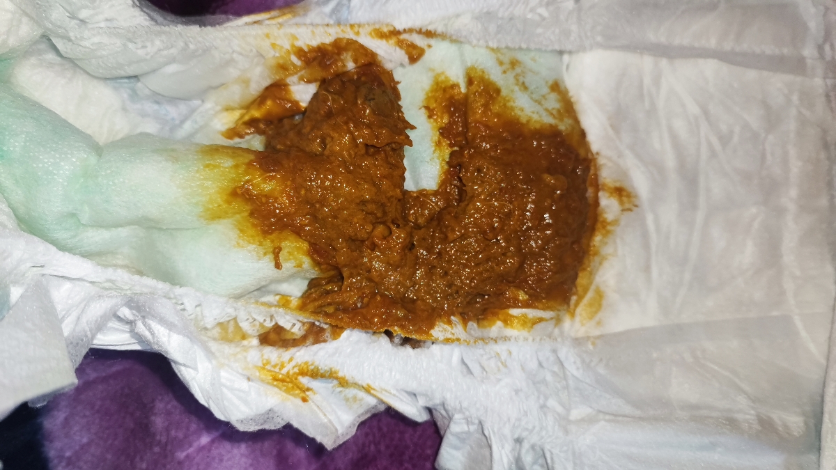 مدفوع شل و و عضم نشدن غذا ..عکس گذاشتم نگاه کنید اگر بدتون میاد