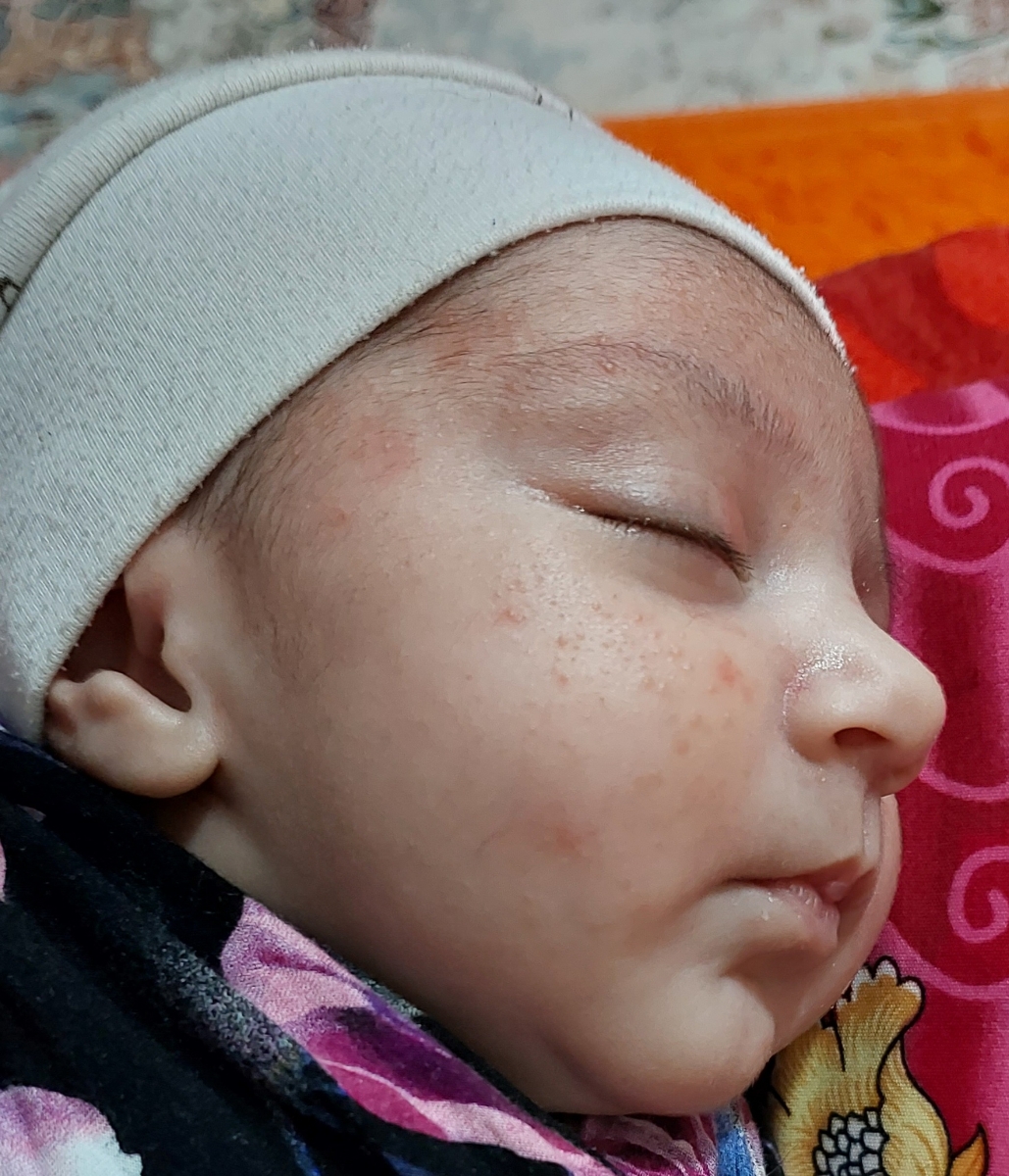 تشخیص حساسیت به پروتیین و تعویض شیر خشک