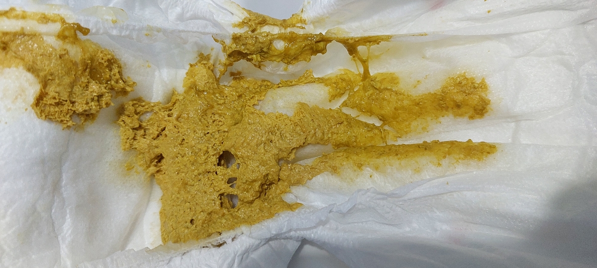 تشخیص حساسیت به پروتیین و تعویض شیر خشک