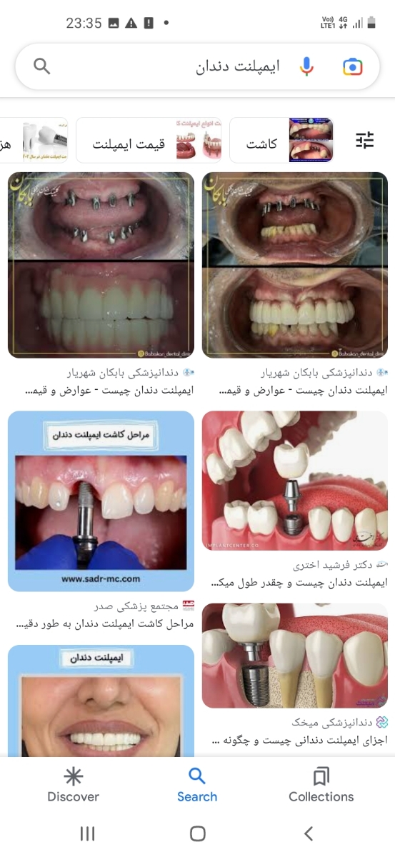 خانما هزینه ایمپلنت هر دندان چقدره