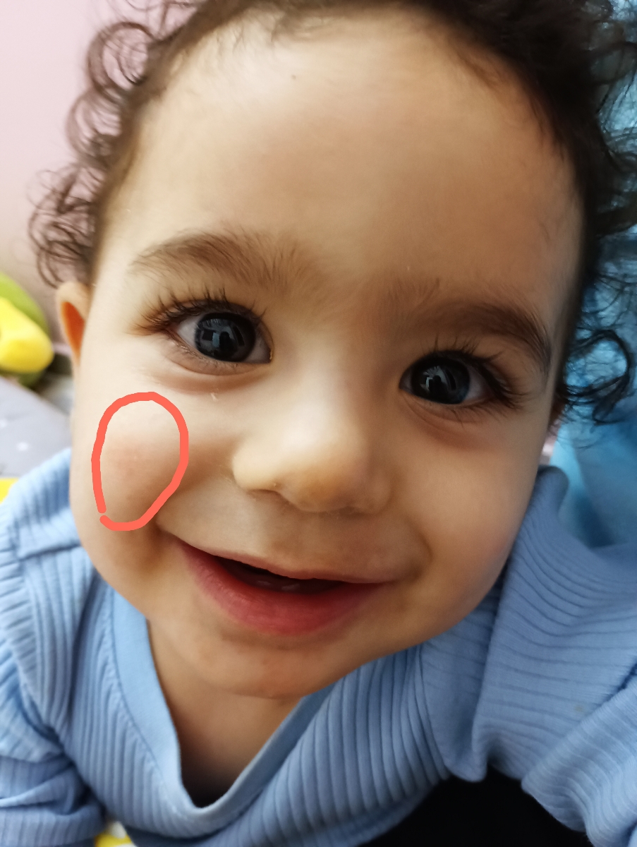 پوست صورت پسرم،اگزما یا چی؟؟