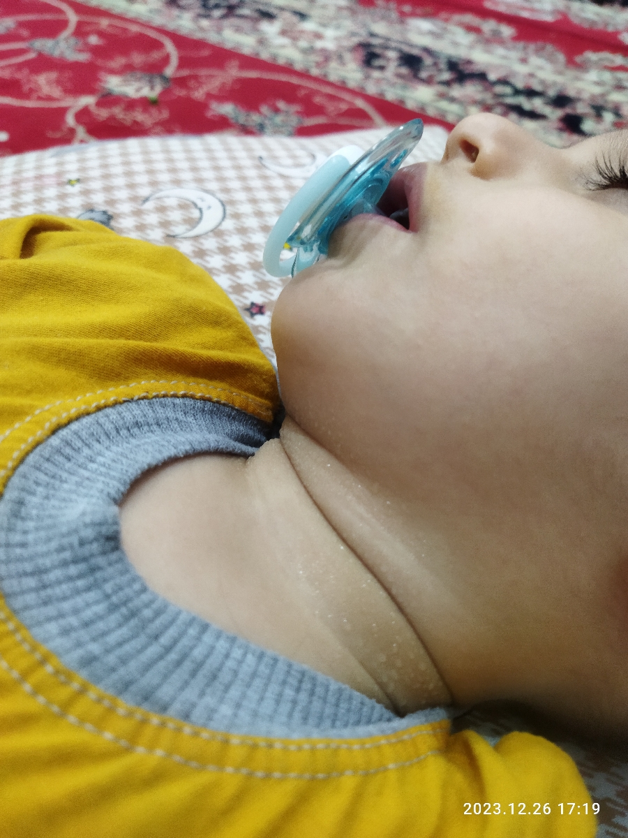 عرق کردن بیش ازحد بچه یکسال و نیمه عرق کردن بیش ازحد بچه یکسال و نیمه