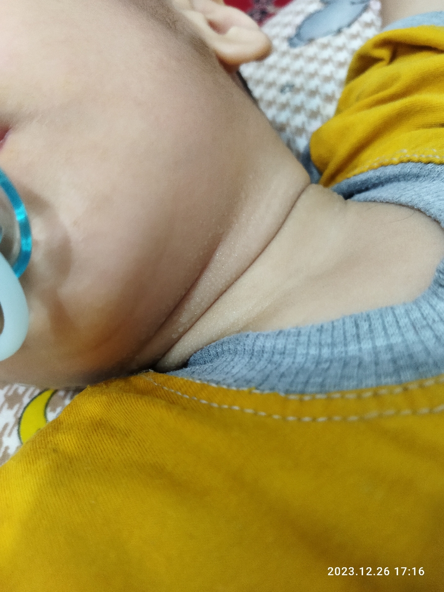عرق کردن بیش ازحد بچه یکسال و نیمه عرق کردن بیش ازحد بچه یکسال و نیمه