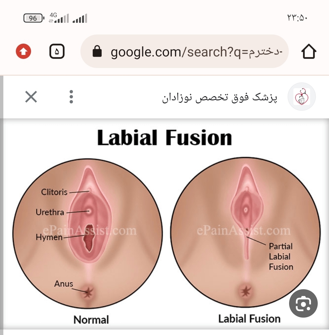 چسبندگی لابیا دختر۲سالم