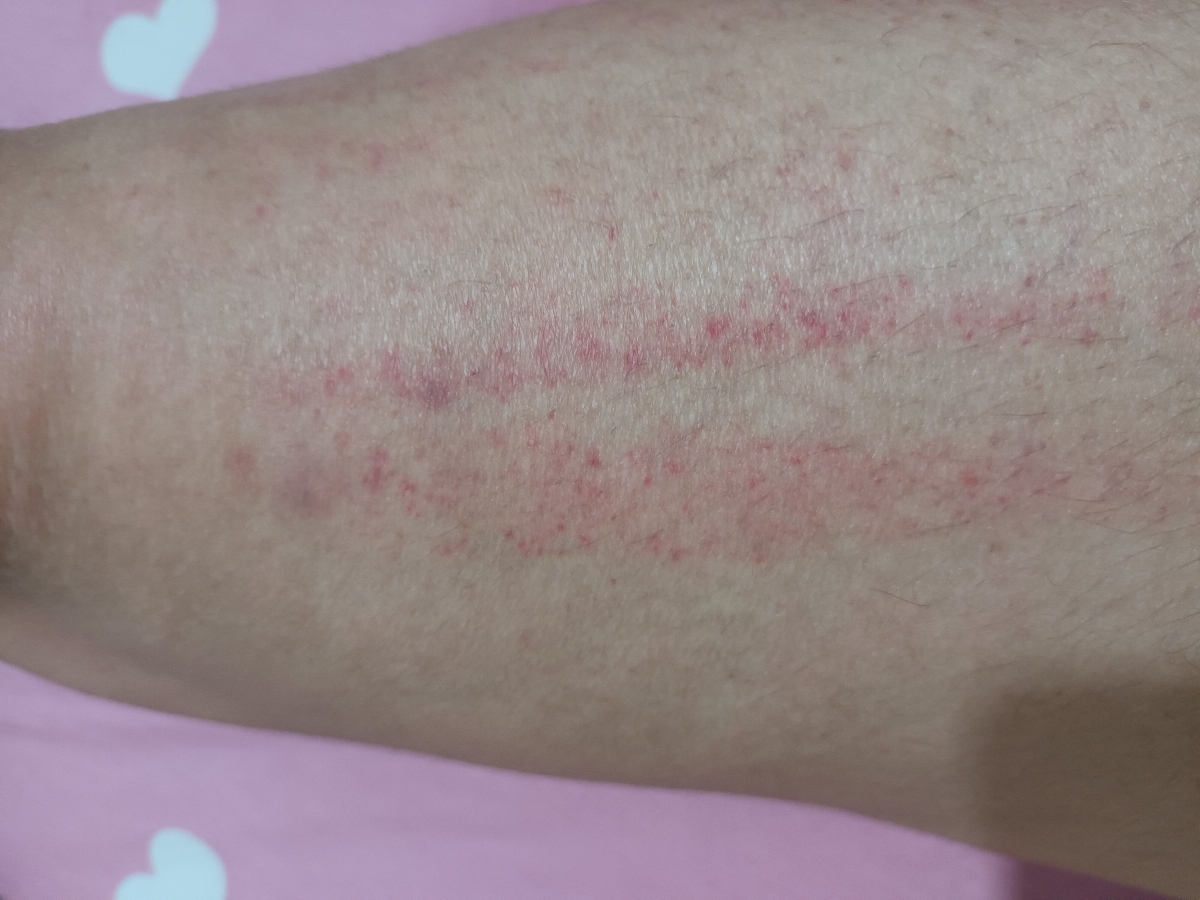 نگا انقد خاروندم ....   رفته رفته بیشتر شد      رفتم دکتر گف حساسیت دادی ب چیزی  دو تا امپول زدن